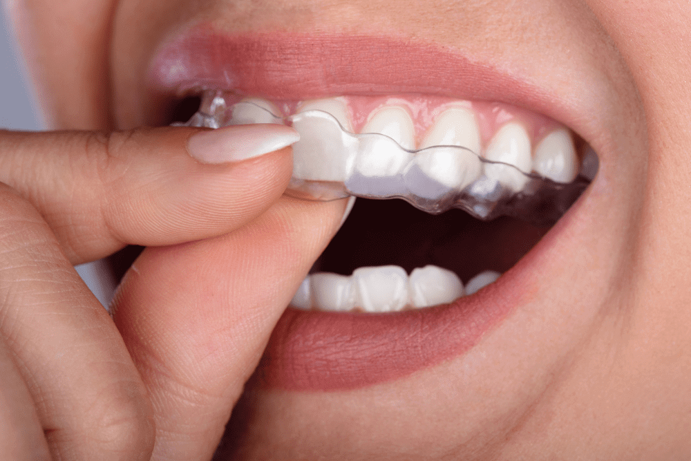 Tratamento ortodôntico. Quando, como e porque realiza-lo? – Implantodontia,  Ortodontia, Odontologia Estética e Digital